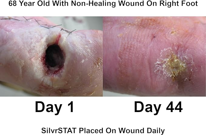 SilvrSTAT First Aid Kit Gel, 32 PPM Silver Healing Wound Dressing Gel, SilverSol Ag₄O₄ Particles, 1 oz