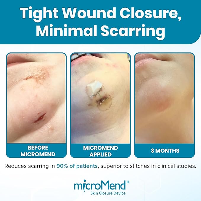 Emergency Wound Closures - Surgical-Grade Laceration Repair Without Stitches | Skin Closure Alternative to Butterfly Bandages | First Aid Kit Essential (6 Medium Wound Closure Devices)