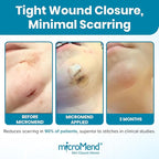 Emergency Wound Closures - Surgical-Grade Laceration Repair Without Stitches | Skin Closure Alternative to Butterfly Bandages | First Aid Kit Essential (6 Medium Wound Closure Devices)