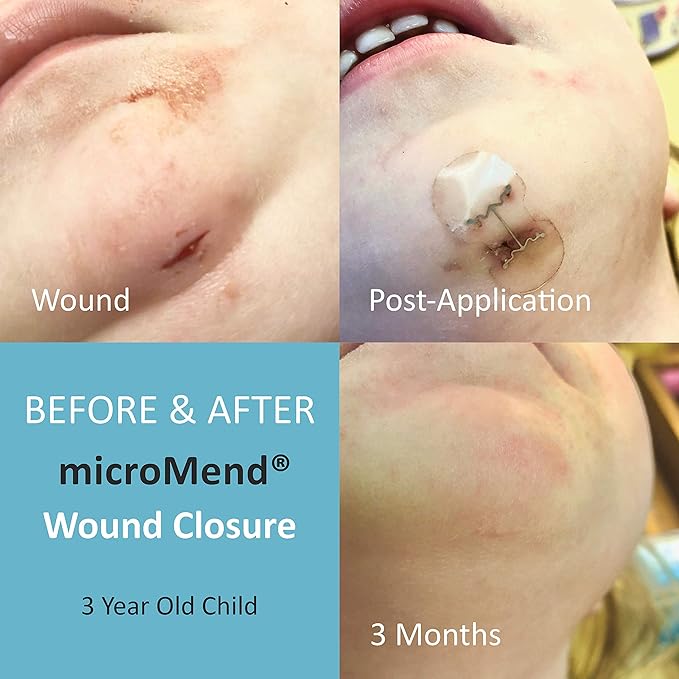 Emergency Wound Closures Surgical Quality Laceration Repair Without Stitches - Think Ahead - Be Prepared- (Emergency Wound Closures XS/SM (2 Devices - 1 Alcohol Prep Pad - 1 Gauze)